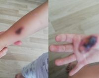 “MR çekilen çocuğun parmakları ve kolu yandı” iddiası