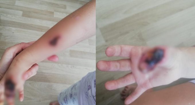 “MR çekilen çocuğun parmakları ve kolu yandı” iddiası